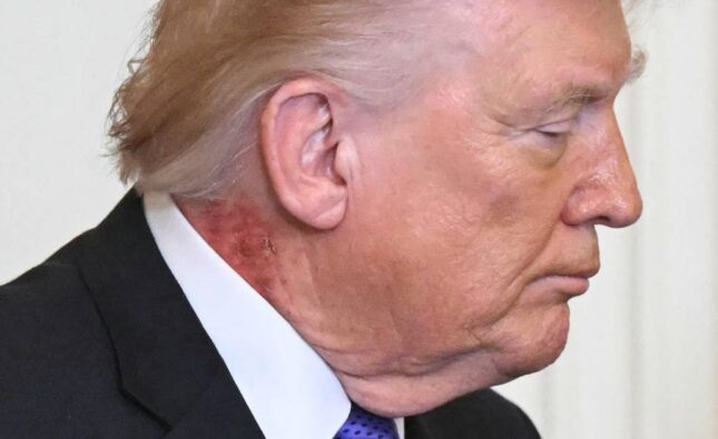 El médico de Donald Trump confirma causas de marcas rojas en su cuello