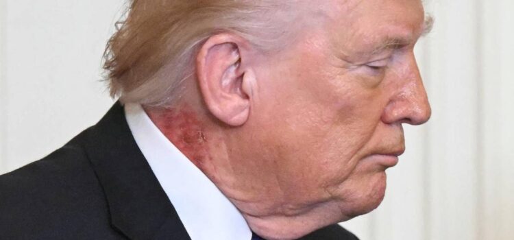 El médico de Donald Trump confirma causas de marcas rojas en su cuello