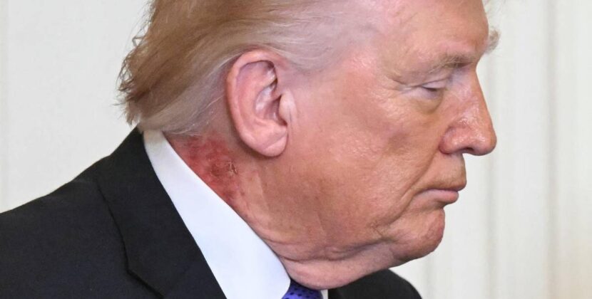 El médico de Donald Trump confirma causas de marcas rojas en su cuello