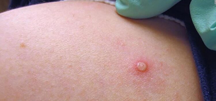 Ministerio confirma diez casos de viruela del mono en Bolivia en 2024